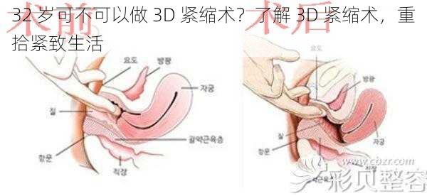 32 岁可不可以做 3D 紧缩术？了解 3D 紧缩术，重拾紧致生活